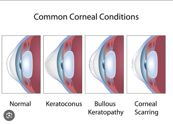 Corneal diseases