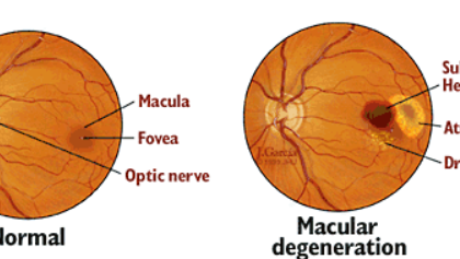 Macular Degeneration