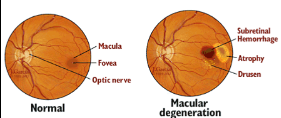 Macular Degeneration