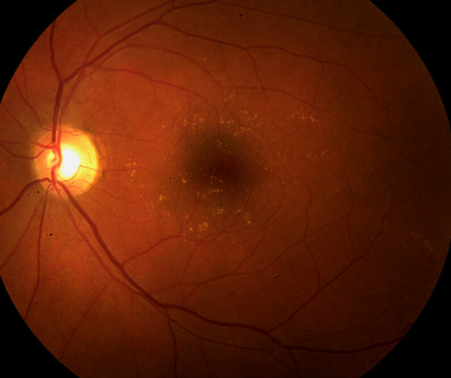 Macular Degeneration