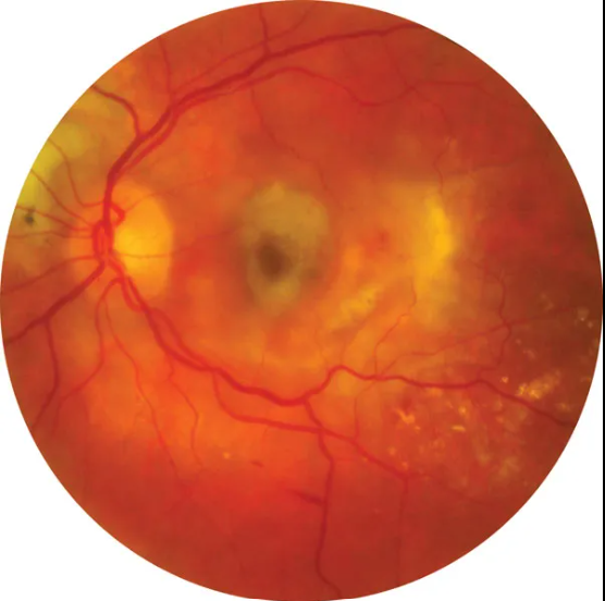 Macular Degeneration