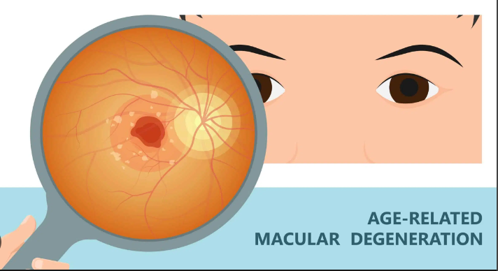 Macular Degeneration