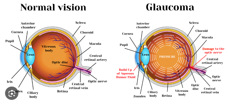 Glaucoma