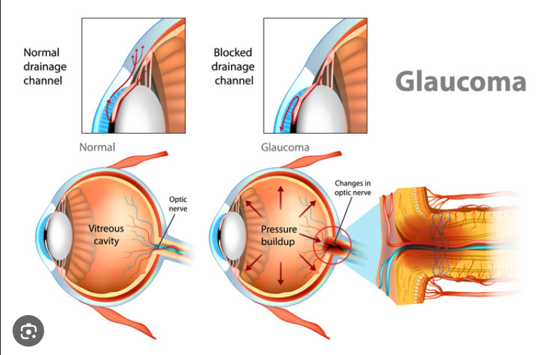 Glaucoma