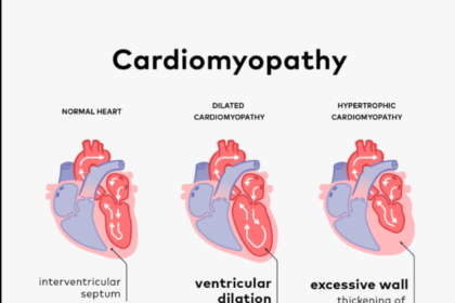 Cardiomyopathy