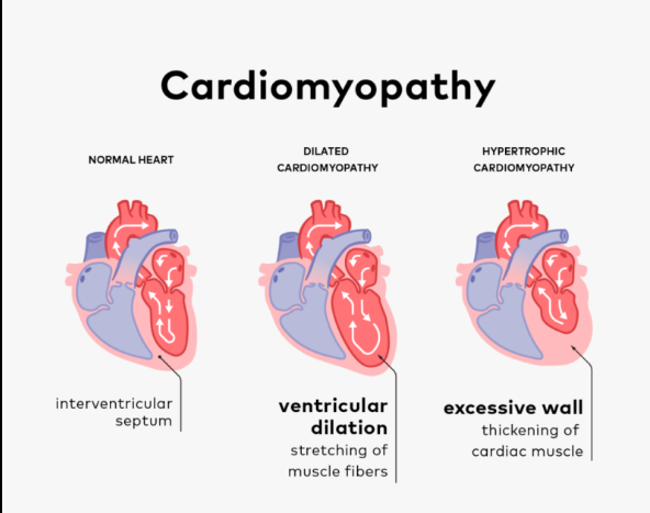 Cardiomyopathy