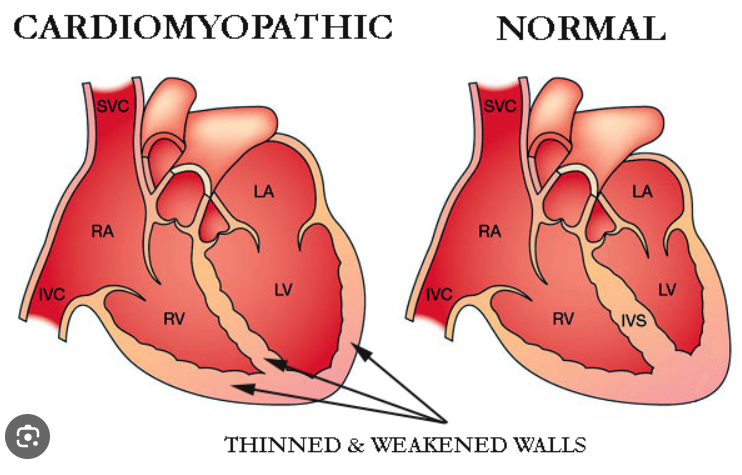 Cardiomyopathy