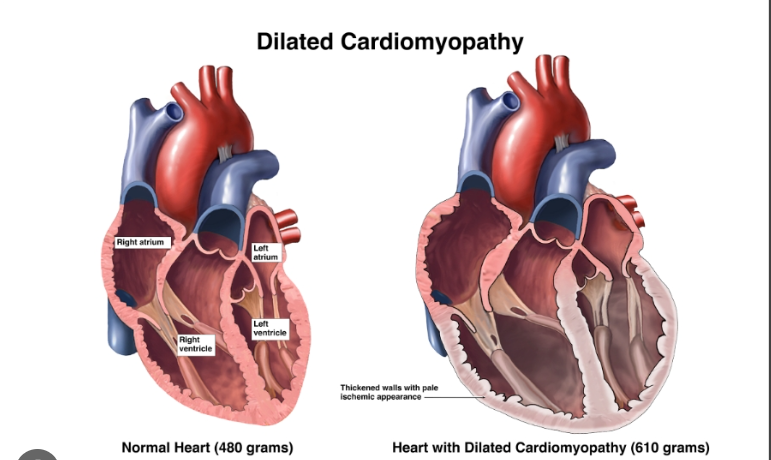 Cardiomyopathy