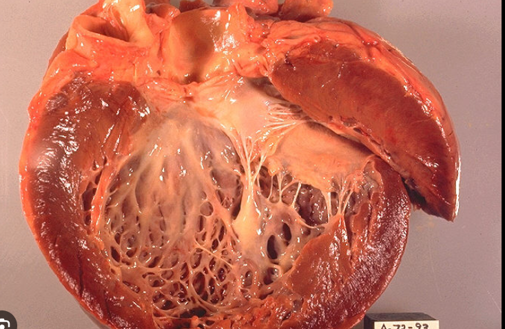 Cardiomyopathy