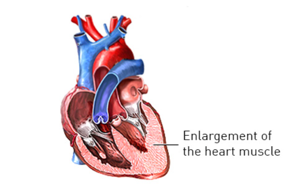 Cardiomyopathy