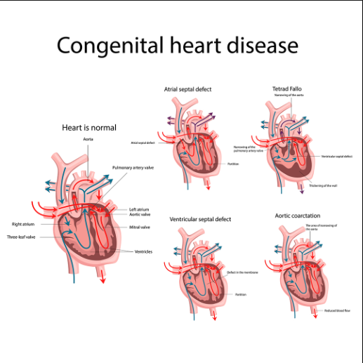 Congenital Heart Disease