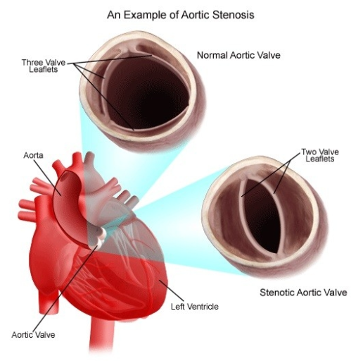 Congenital Heart Disease