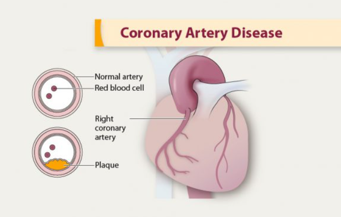 Coronary Artery Disease