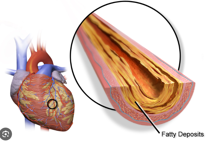 Coronary Artery Disease