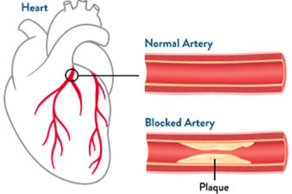 Coronary Artery Disease