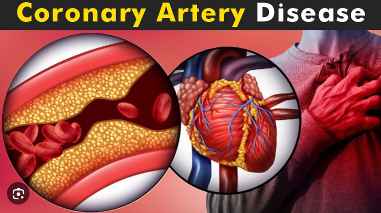 Coronary Artery Disease