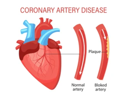 Coronary Artery Disease