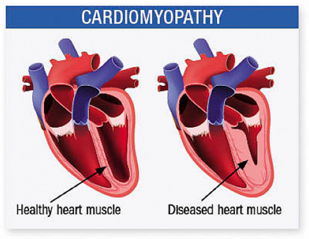 Enlarged Heart 