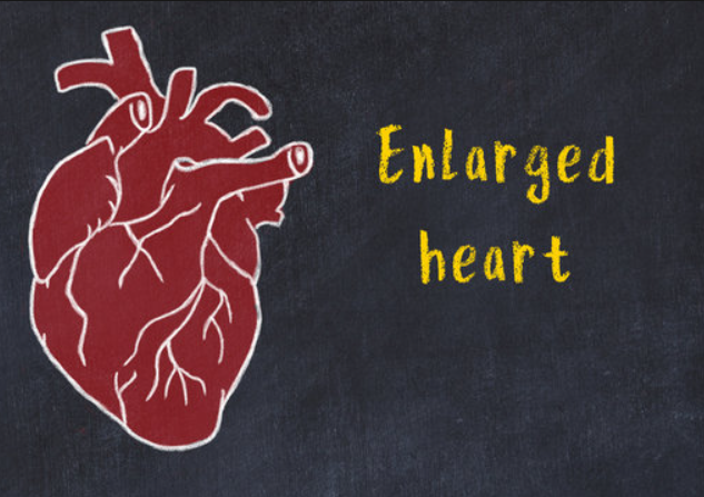 Enlarged Heart