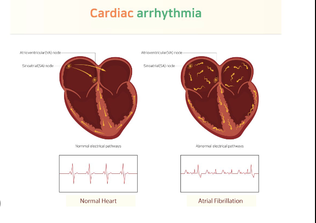 Heart Arrhythmias