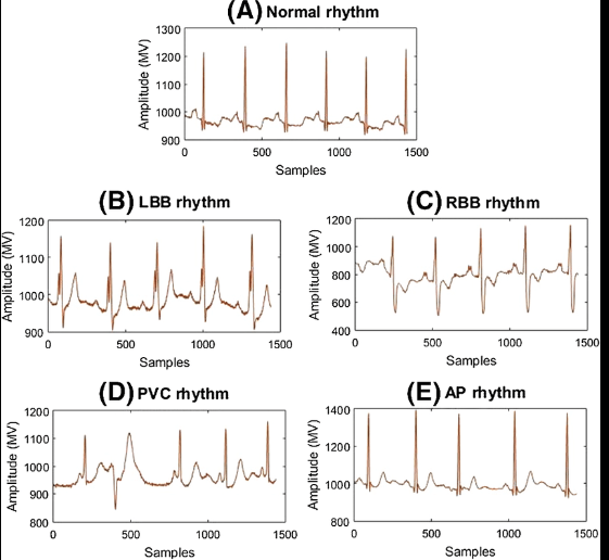 Heart Arrhythmias