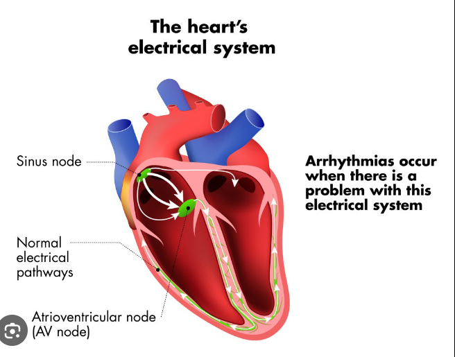 Heart Arrhythmias