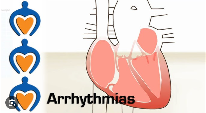 Heart Arrhythmias