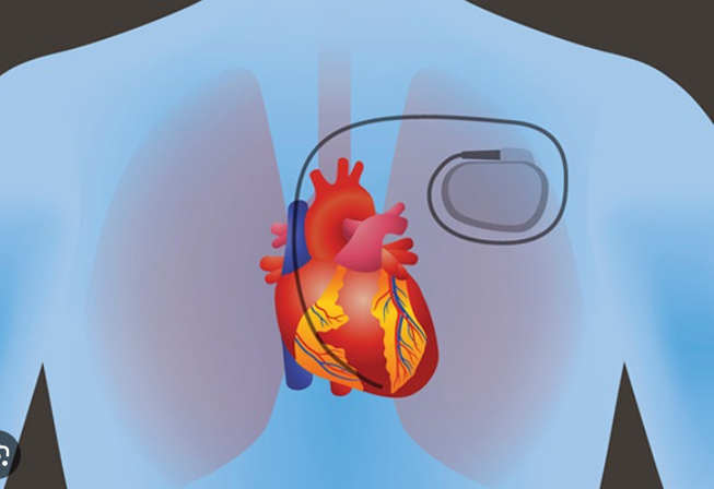 Heart Arrhythmias