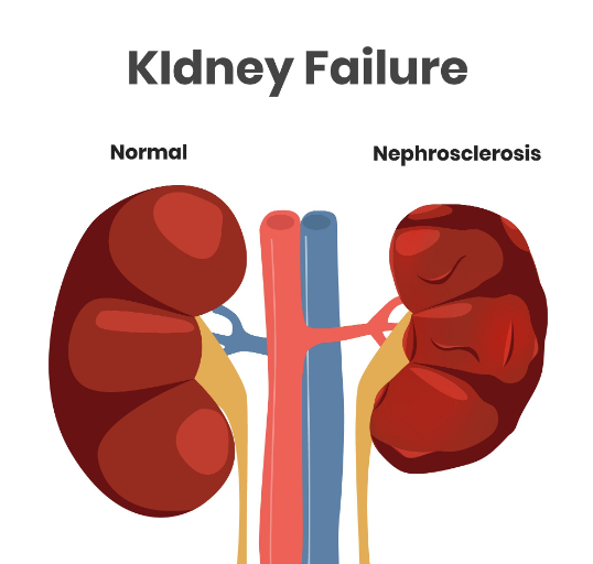 renal failure