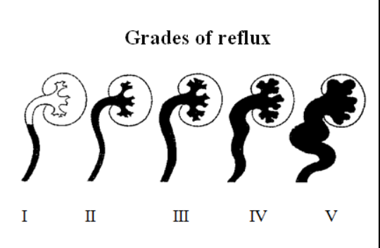 Kidney Reflux