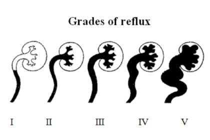 Kidney Reflux