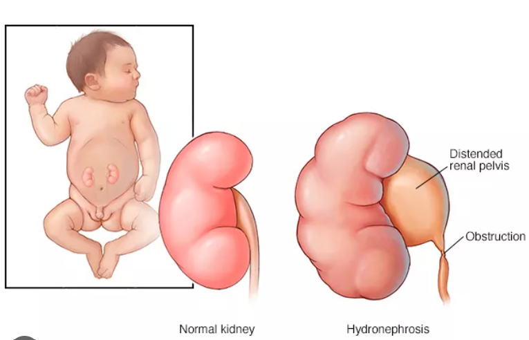 Kidney Reflux