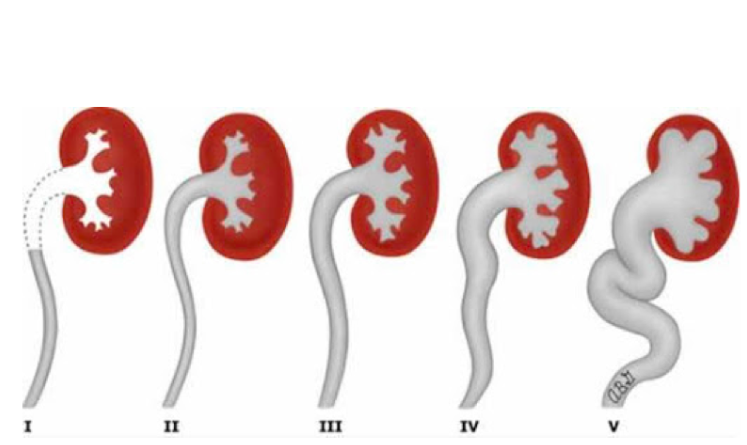 Kidney Reflux