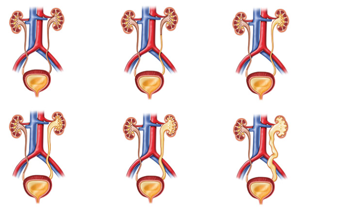 Kidney Reflux