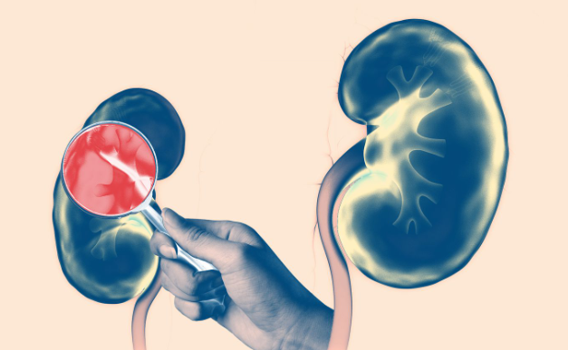 kidney disease