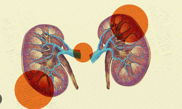 kidney disease