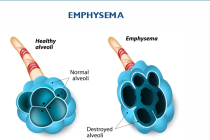 Emphysema