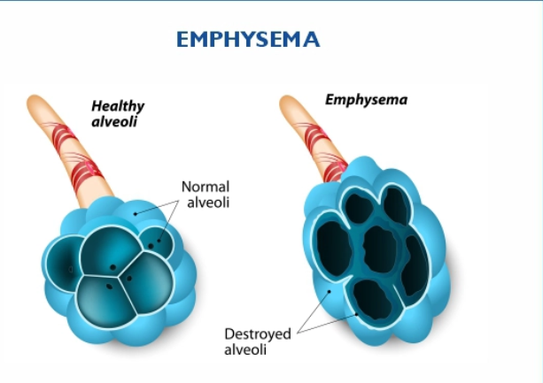 Emphysema