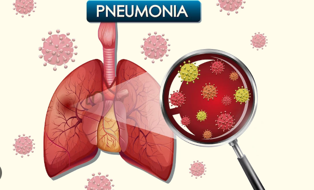 Pneumonia