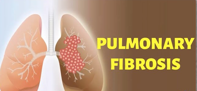 Pulmonary Fibrosis