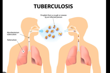 Tuberculosis