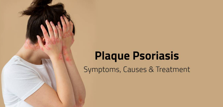 plaque Psoriasis