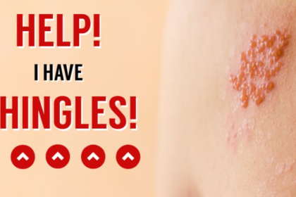 Shingles