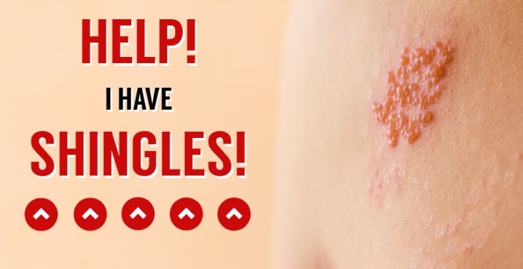 Shingles