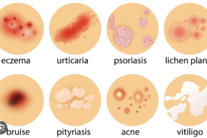 Skin Diseases