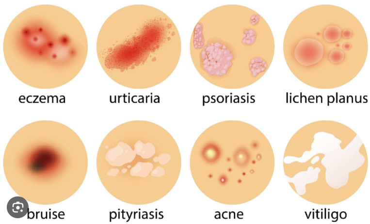 Skin Diseases