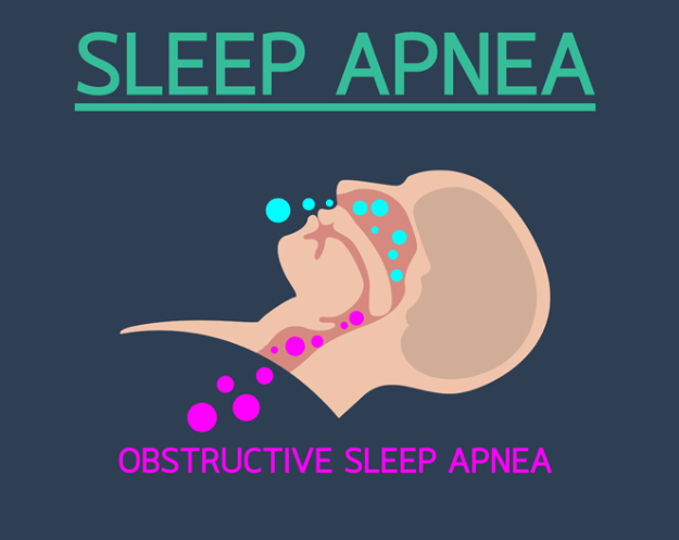 sleep apnea