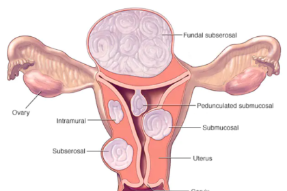 Fibroids