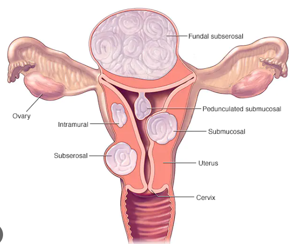 Fibroids