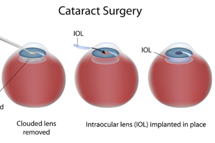 Cataract Surgery